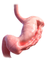 Endoscopic Sleeve Image
